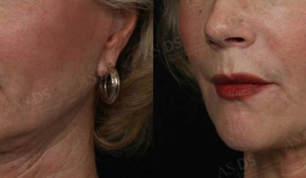 فیلر هیالورونیک اسید