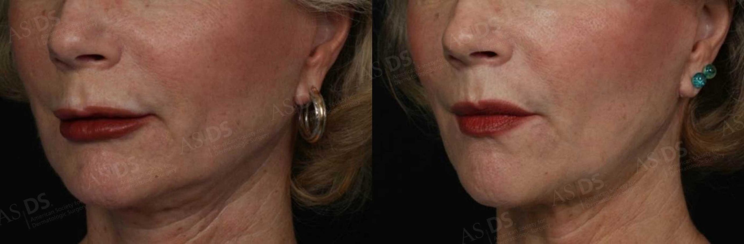 فیلر هیالورونیک اسید