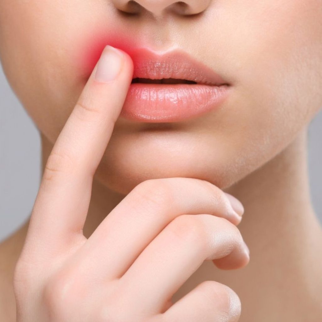 از بین بردن ورم لب بعد از تزریق  ژل