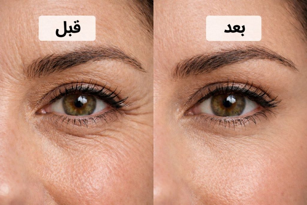 مزوتراپی زیر چشم
