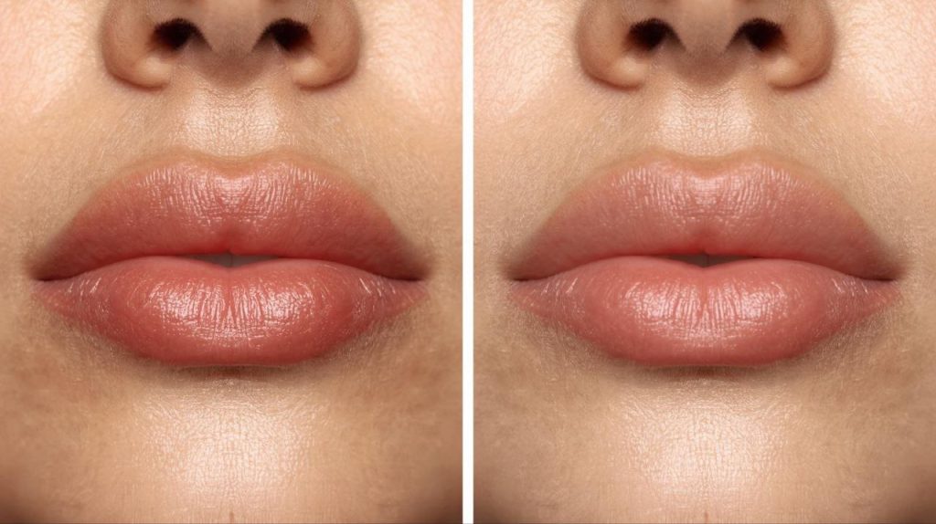 میکروپیگمنتیشن چیست؟